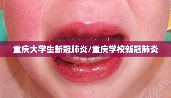 重庆大学生新冠肺炎/重庆学校新冠肺炎