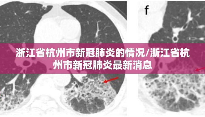 浙江省杭州市新冠肺炎的情况/浙江省杭州市新冠肺炎最新消息